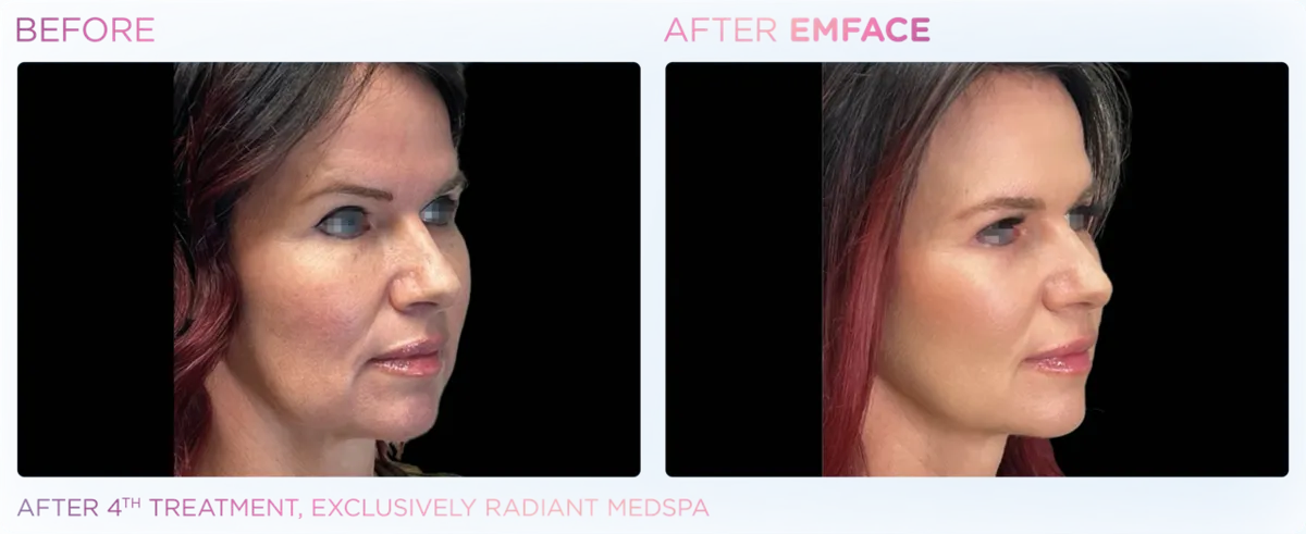 EMFACE rezultāti