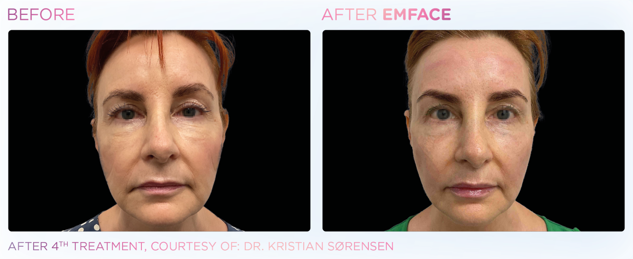 EMFACE pirms un pēc